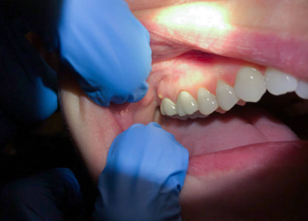 Best Knocked-Out Tooth Emergency  in Sumiton, AL